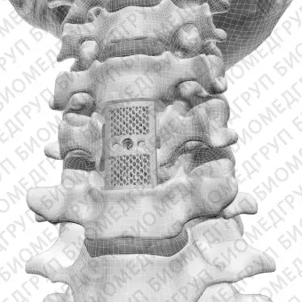 Шейный позвоночный протез F3D