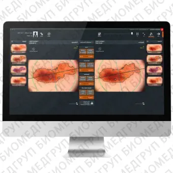 FotoFinder Moleanalyser Pro Дерматоскоп