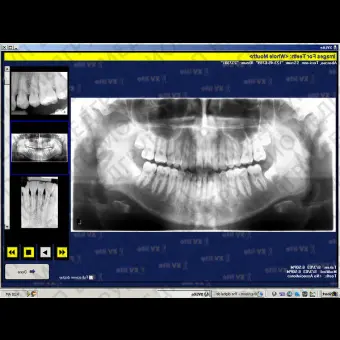 Программное обеспечение для обработки снимков зубов XrayVision