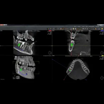 Программное обеспечение для обработки снимков зубов QuickVision 3D