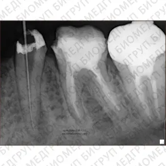 PORTX II NEW  портативный высокочастотный интраоральный рентгеновский аппарат