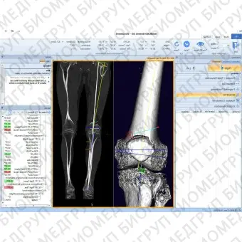Медицинское программное обеспечение mediCAD 3D Knee